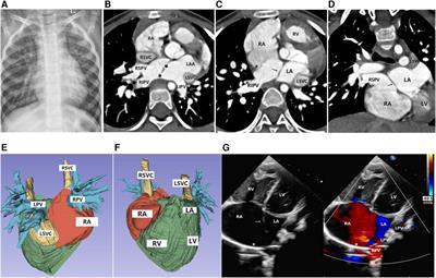 Anomalous pulmonary venous drainage due to malposition of septum primum: two case reports and literature review